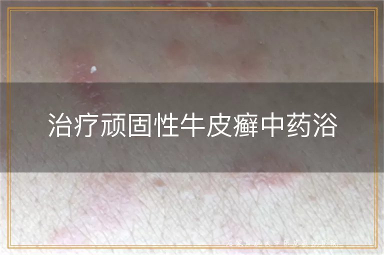 治疗顽固性牛皮癣中药浴