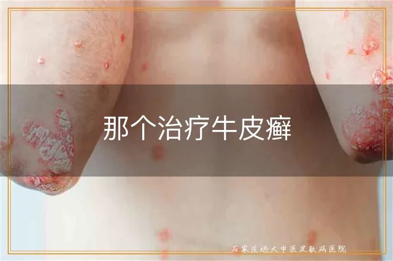 那个治疗牛皮癣