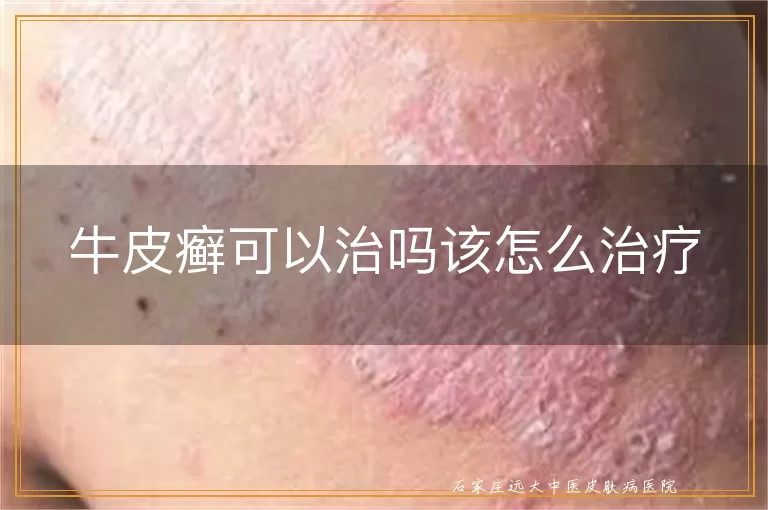 牛皮癣可以治吗该怎么治疗