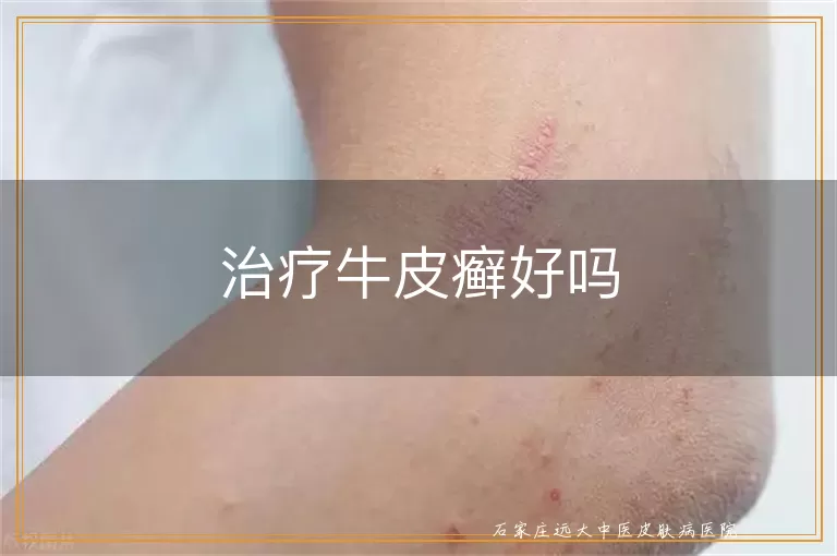 治疗牛皮癣好吗