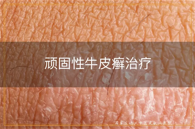 顽固性牛皮癣治疗