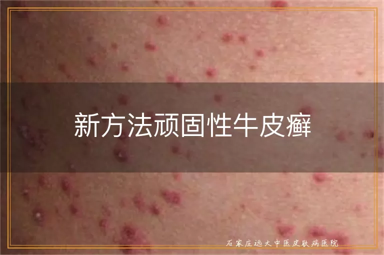 新方法顽固性牛皮癣