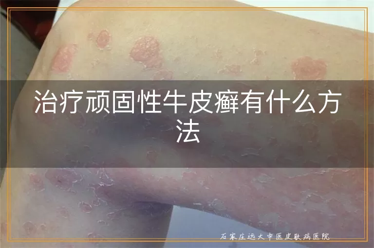 治疗顽固性牛皮癣有什么方法