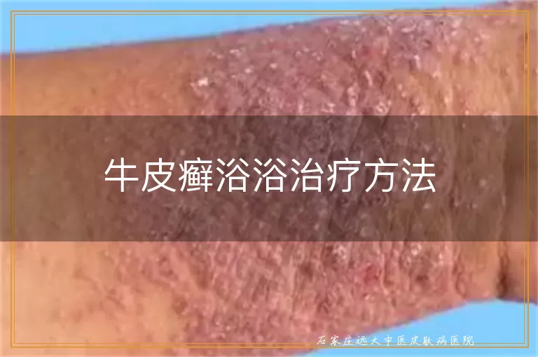 牛皮癣浴浴治疗方法