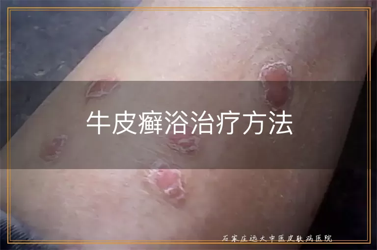 牛皮癣浴治疗方法