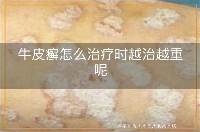 牛皮癣怎么治疗时越治越重呢