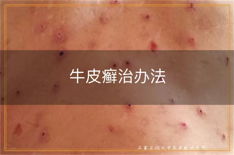 牛皮癣治办法