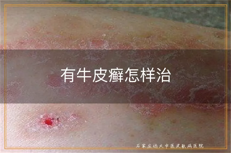 有牛皮癣怎样治