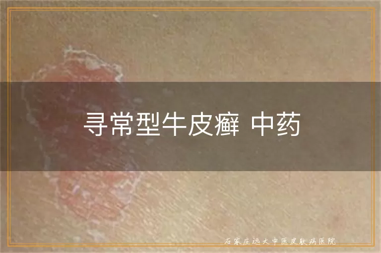 寻常型牛皮癣 中药