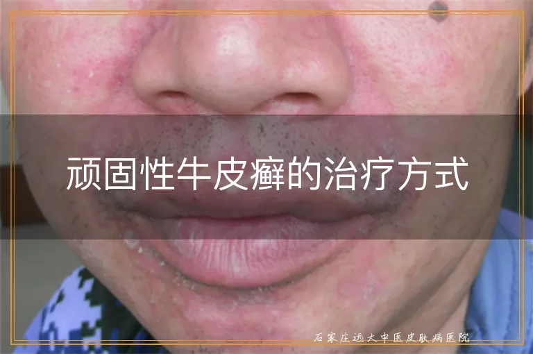 顽固性牛皮癣的治疗方式