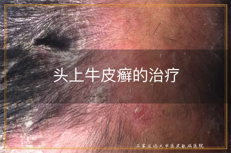 头上牛皮癣的治疗