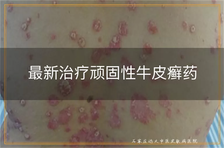 最新治疗顽固性牛皮癣药