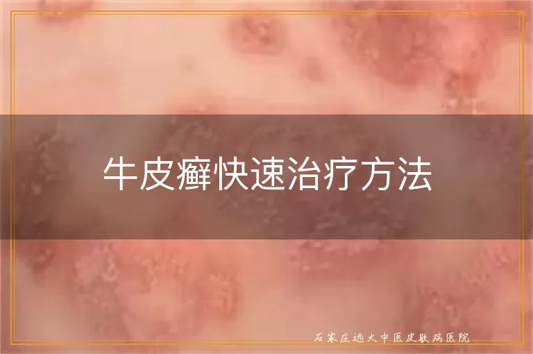 牛皮癣快速治疗方法
