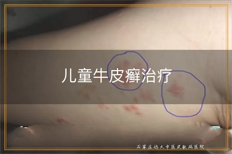 儿童牛皮癣治疗