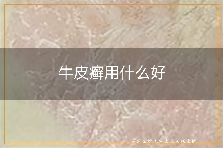 牛皮癣用什么好
