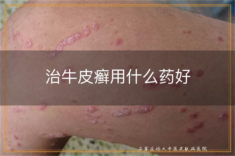治牛皮癣用什么药好