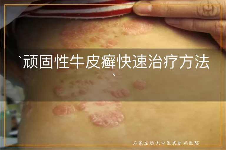 顽固性牛皮癣快速治疗方法