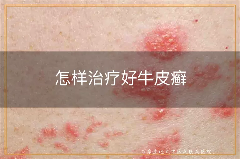 怎样治疗好牛皮癣