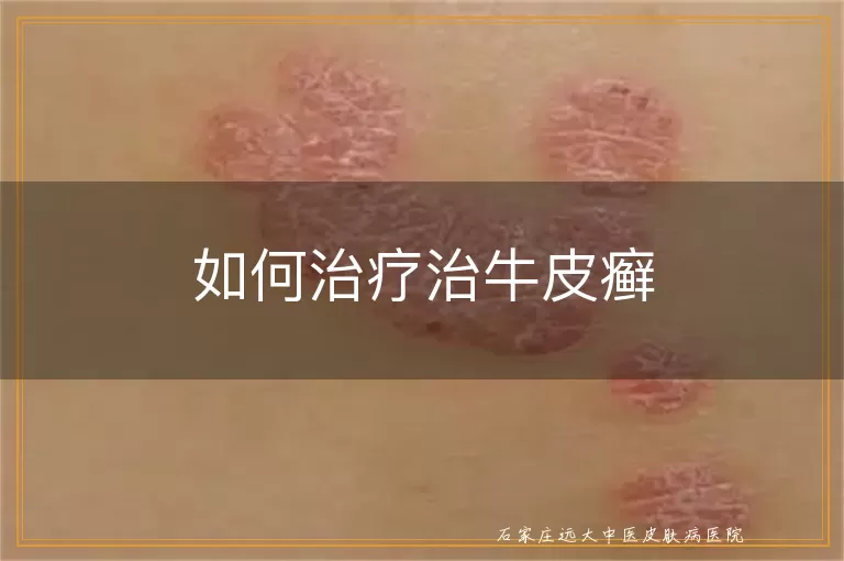 如何治疗治牛皮癣