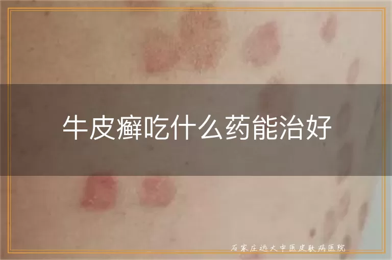 牛皮癣吃什么药能治好