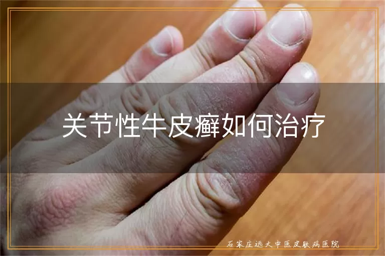 关节性牛皮癣如何治疗