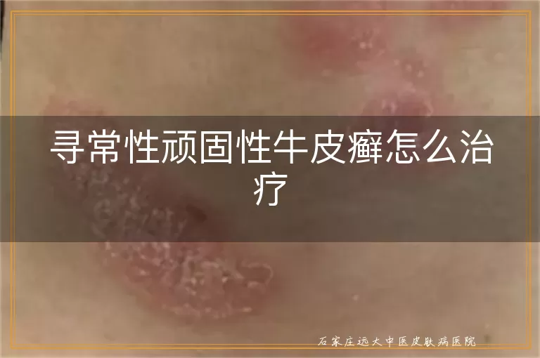 寻常性顽固性牛皮癣怎么治疗