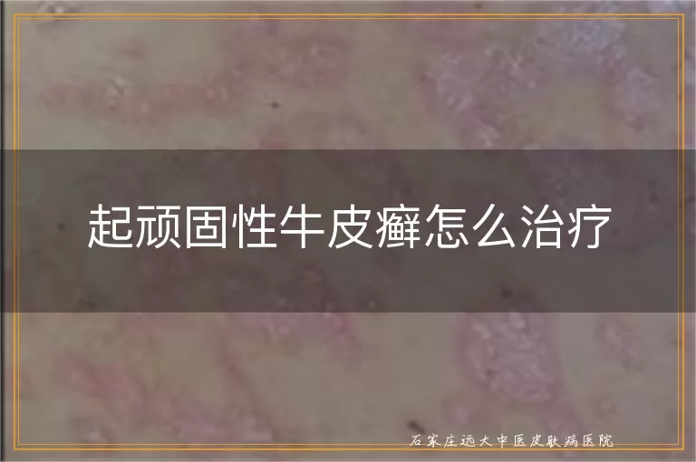 起顽固性牛皮癣怎么治疗