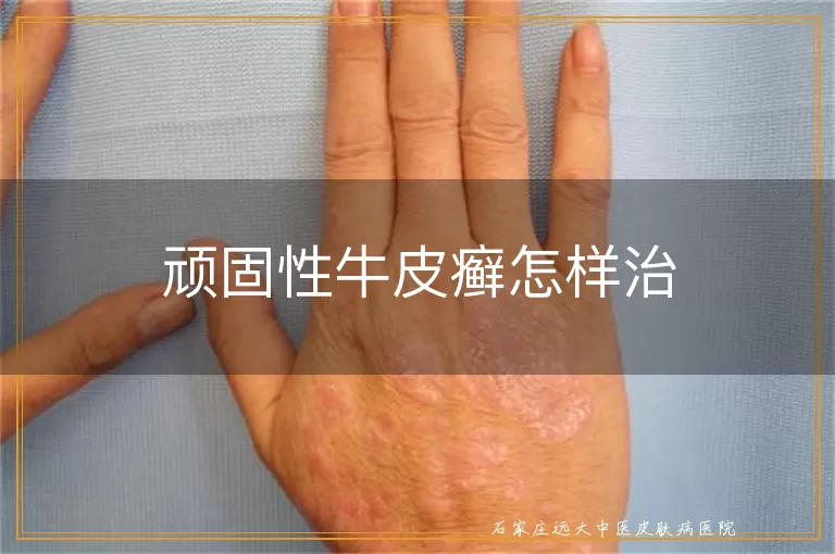 顽固性牛皮癣怎样治
