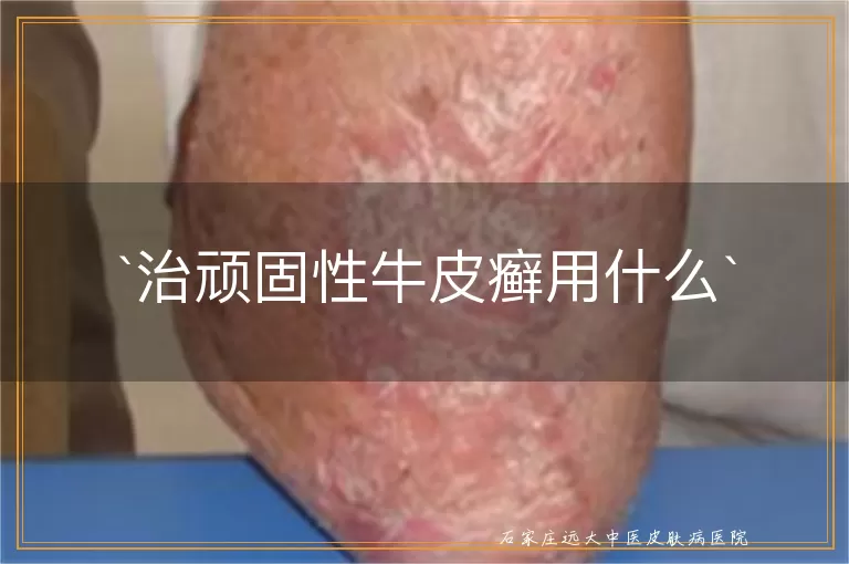 治顽固性牛皮癣用什么