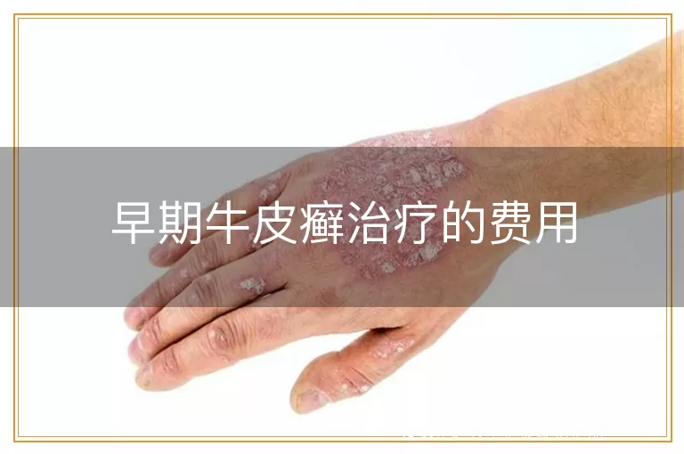 早期牛皮癣治疗的费用