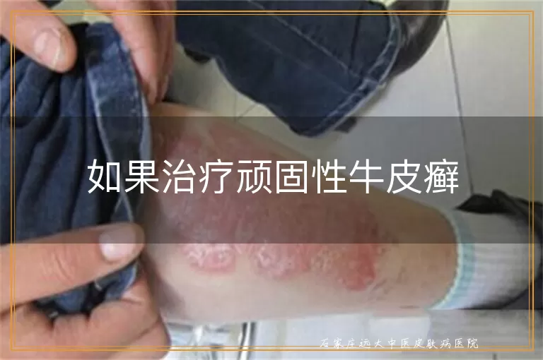 如果治疗顽固性牛皮癣