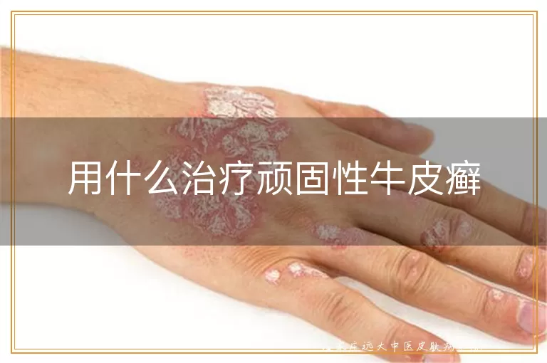 用什么治疗顽固性牛皮癣
