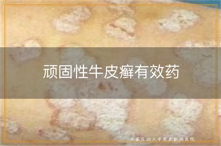 顽固性牛皮癣有效药