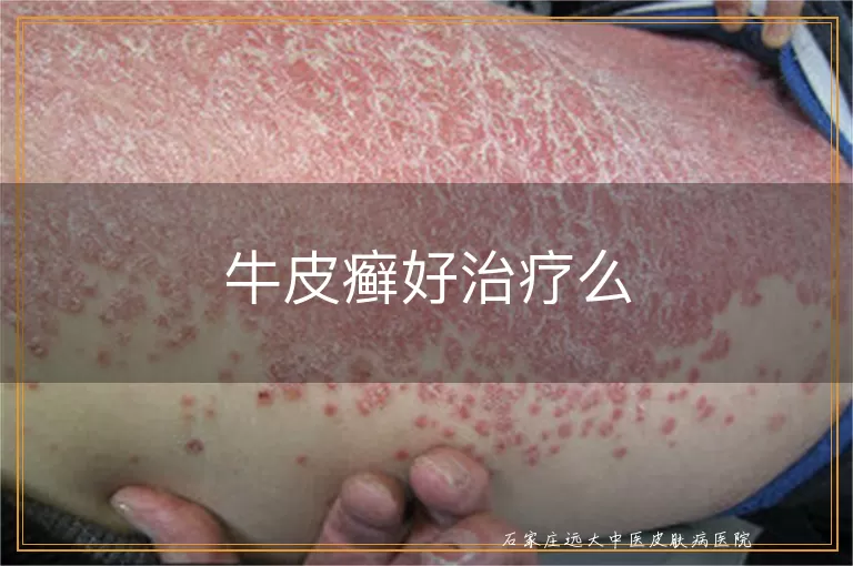 牛皮癣好治疗么