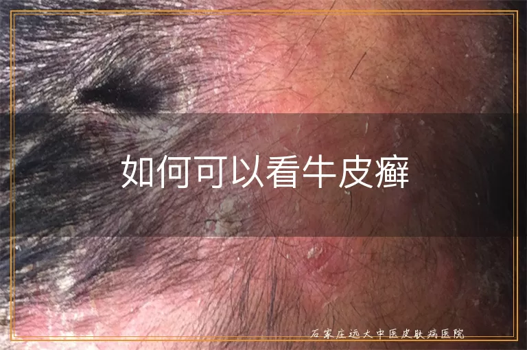 如何可以看牛皮癣