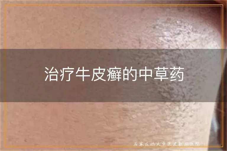 治疗牛皮癣的中草药