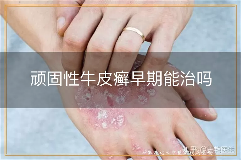顽固性牛皮癣早期能治吗