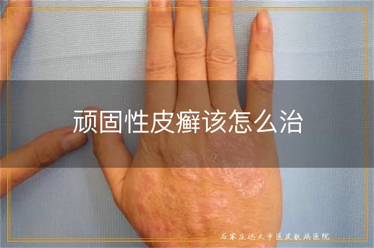 顽固性皮癣该怎么治