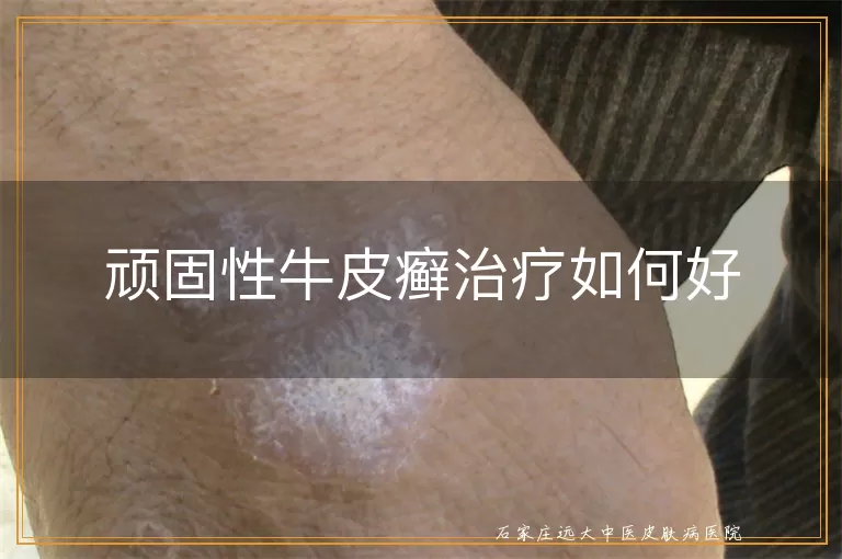 顽固性牛皮癣治疗如何好