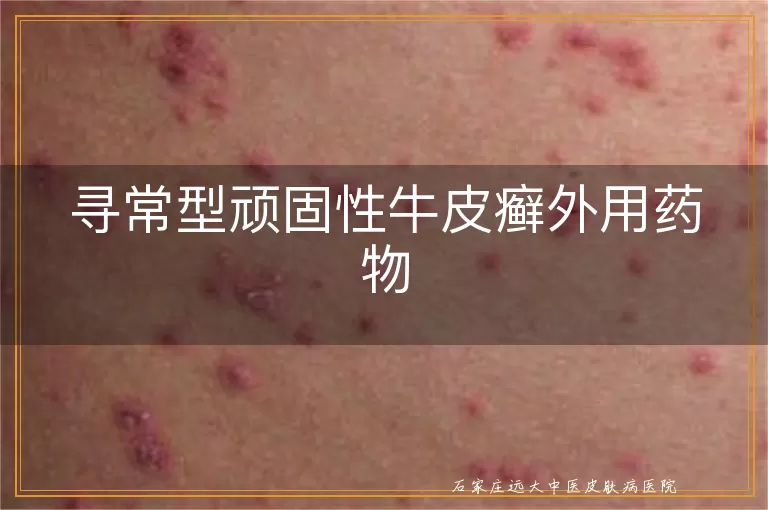 寻常型顽固性牛皮癣外用药物