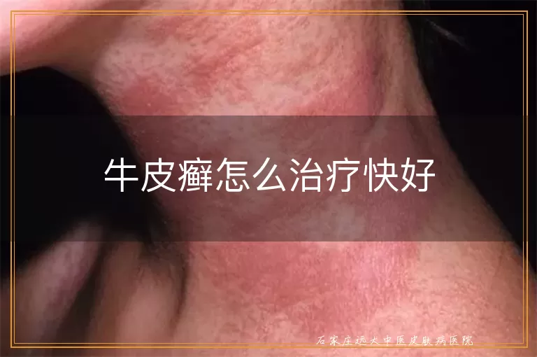 牛皮癣怎么治疗快好