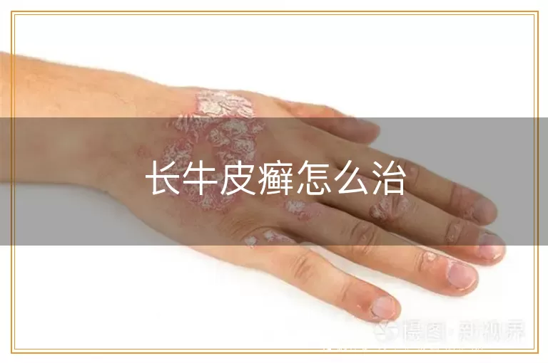 长牛皮癣怎么治