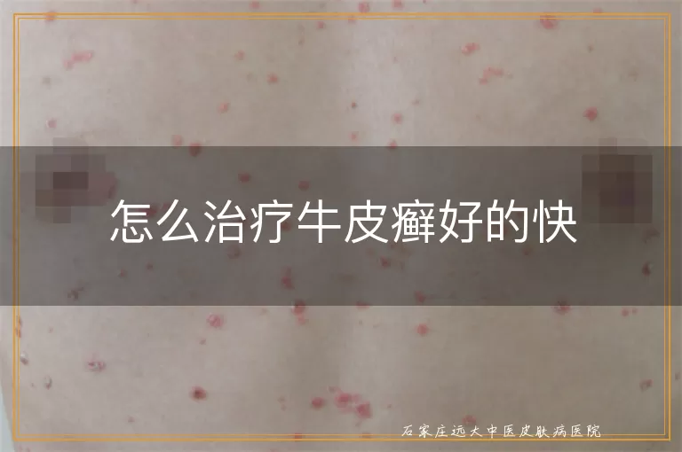 怎么治疗牛皮癣好的快