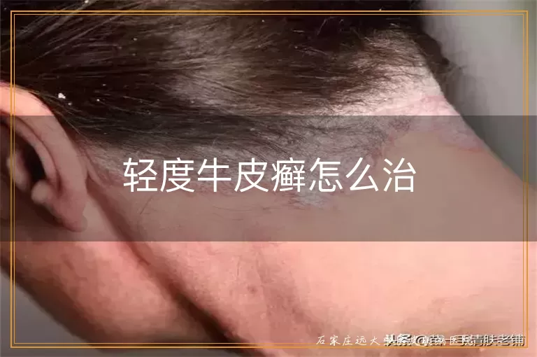 轻度牛皮癣怎么治