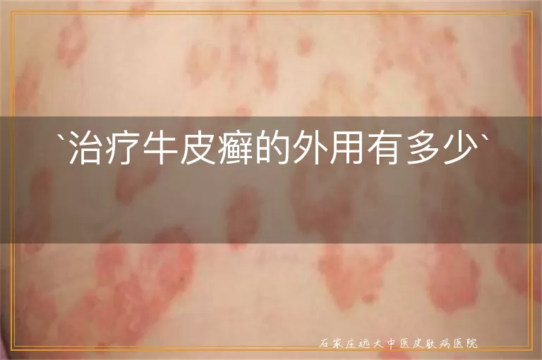 治疗牛皮癣的外用有多少