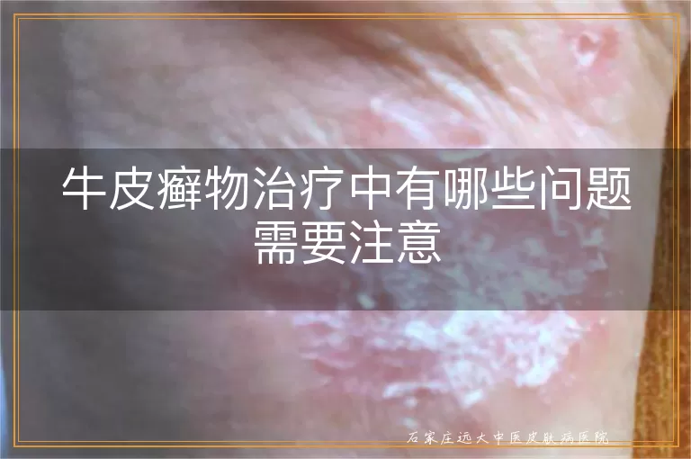 牛皮癣物治疗中有哪些问题需要注意