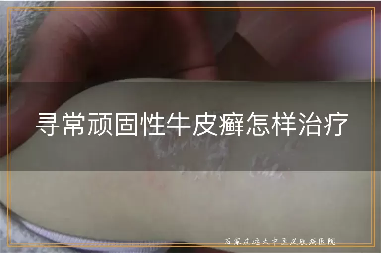 寻常顽固性牛皮癣怎样治疗