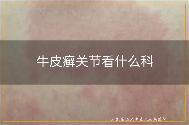 牛皮癣关节看什么科