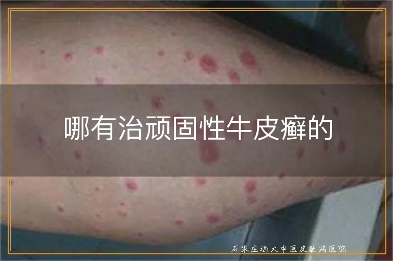 哪有治顽固性牛皮癣的