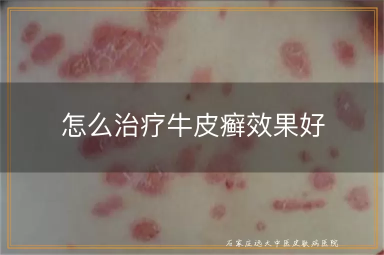 怎么治疗牛皮癣效果好